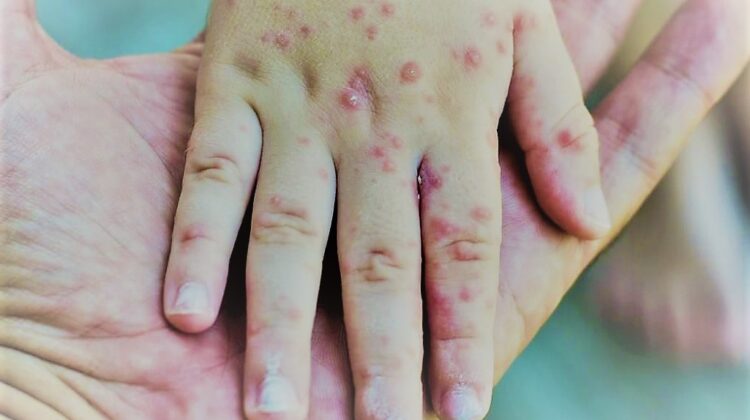 Qızılca yenə can aldı - Virus Azərbaycandan nə vaxt “çıxacaq”?