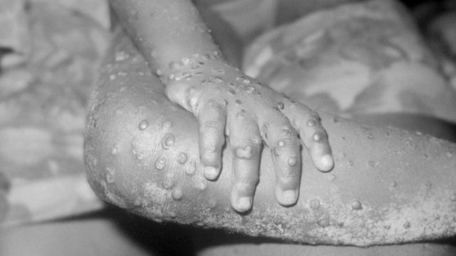 Azərbaycanda meymunçiçəyi virusu ilə bağlı daha bir qurum HƏRƏKƏTƏ KEÇDİ