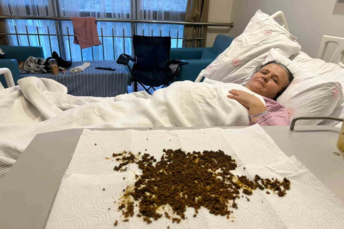 Türkiyədə pasiyentin öd kisəsindən 20 mindən çox daş çıxarıldı