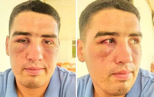 Şahidlər döyüldüyünü, polis isə yıxılıb xəsarət aldığını deyir