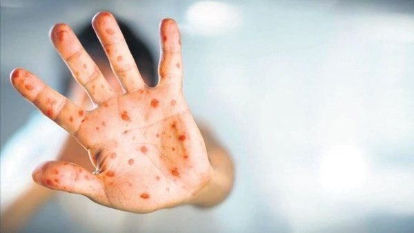 Azərbaycanda meymunçiçəyi virusuna ilk yoluxma faktı aşkarlanıb - RƏSMİ